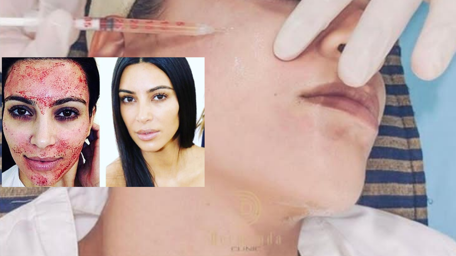  Dermand Clinic تقدم تقنية الـ”PRP” بجودة عالية واهتمامٍ لا مثيل له - صورة مميزة صورة مميزة: Dermand Clinic تقدم تقنية الـ”PRP” بجودة عالية واهتمامٍ لا مثيل له