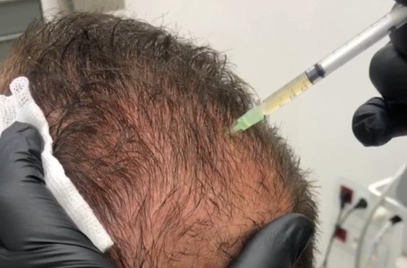 صورة مميزة: تعرفوا على بلازما الشعر مع رامي عبادي