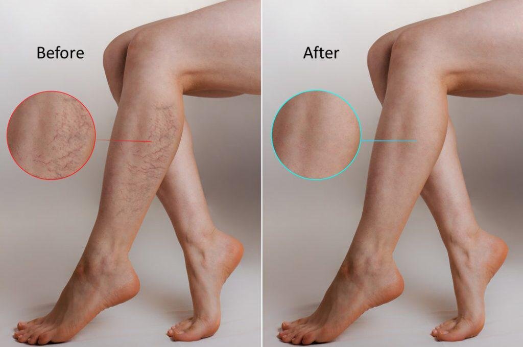 العيادة الطبية التجميلية “Carnaby Laser Clinic and Academy” تُعالج الأوردة العنكبوتية بواسطة الليزر - صورة مميزة صورة مميزة: العيادة الطبية التجميلية “Carnaby Laser Clinic and Academy” تُعالج الأوردة العنكبوتية بواسطة الليزر